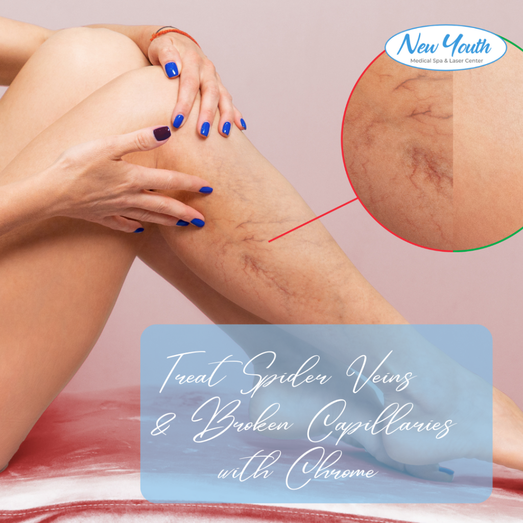 Treat Spider Veins and Broken Capillaries with chrome at New Youth Medical Spa