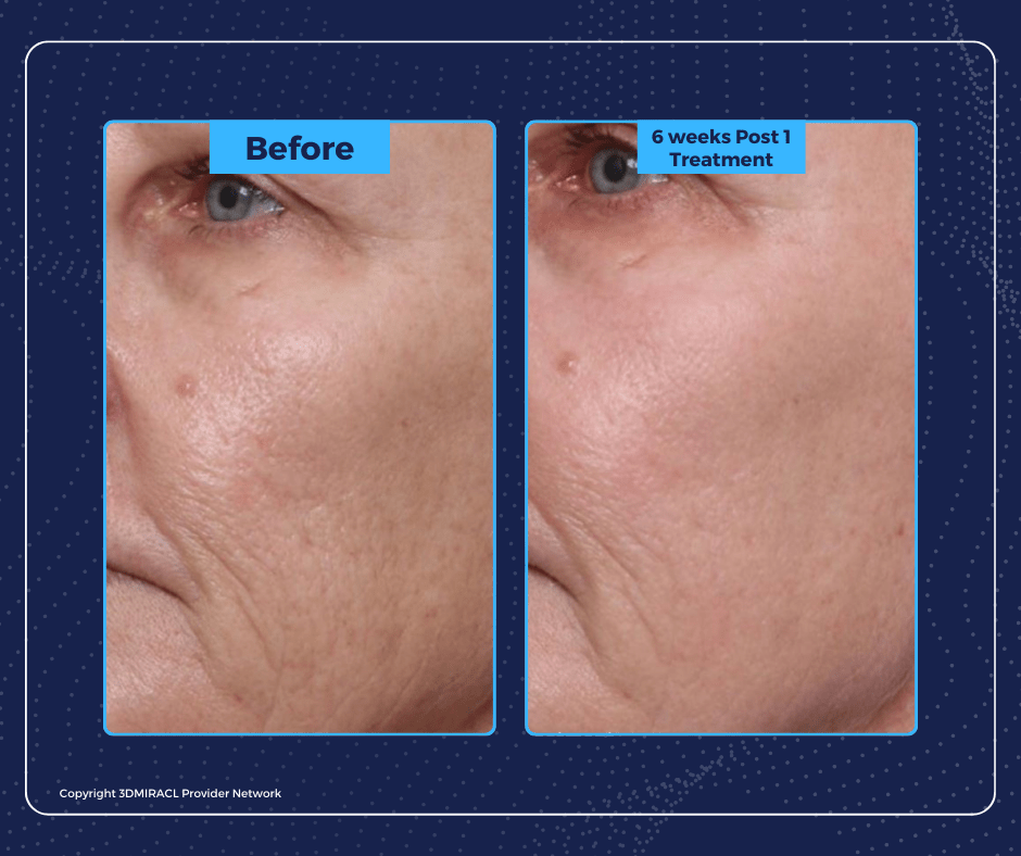 UltraClear-Laser-Before-and-After